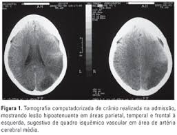 We did not find results for: Scielo Brasil Afasia Global Sem Hemiparesia Avc Ou Transtorno Conversivo Afasia Global Sem Hemiparesia Avc Ou Transtorno Conversivo
