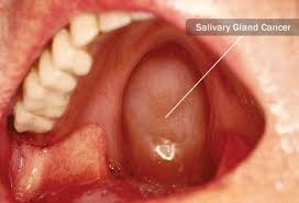 While various forms of cancer can be quite common in older cats, cancer of the throat and larynx are fairly rare in cats of any age. Head And Neck Cancers Symptoms And Treatments
