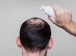For me it caused more hair loss in 7 months than in the last 20yrs. Does Rogaine Expire Everything To Know