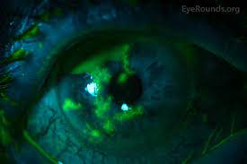 Keratitis (corneal infection and inflammation) caused by herpes simplex virus (hsv) is a major cause of blindness worldwide, due to herpes simplex keratitis. Hsv Keratitis Eyerounds Org Online Ophthalmic Atlas