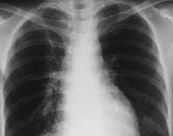 Metastatic cancer to the bone. Thoracic Manifestations Of Breast Cancer And Its Therapy Radiographics
