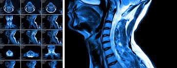 Related online courses on physioplus. Cervical Myelopathy Johns Hopkins Medicine