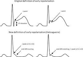 Image result for Early Repolarization