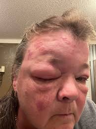 Hello, I am being treated for shingles, and while I was at the doctors  office, I mentioned being surprised that I would get shingles at age 36.  The nurse mentioned that while