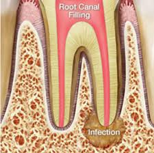 A gum infection — when the gums around the tooth become infected, it is more likely. There S Still Hope For A Re Infected Tooth After Root Canal Treatment