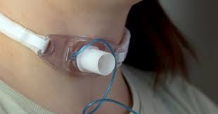 Image result for Tracheostomy