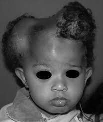 Encephalocraniocutaneous Lipomatosis (Haberland's Syndrome)