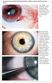Image result for Eye Foreign Body