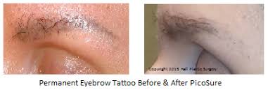 eyebrow tattoo removal before and after