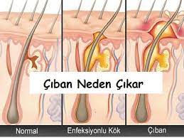 ciban nedir neden cikar ve nasil gecer saglik haberleri ciban tedavisi saglik haber