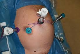 Some surgeries may involve placing a mesh patch to support and strengthen the weakened area. Evolution Of Male Rectal Prolapse Surgery And Initial Experience Of Robotic Rectopexy In Men Springerlink