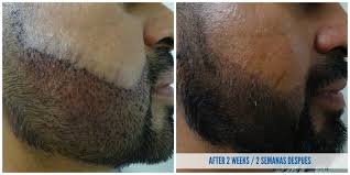 Beard hair transplant to head. Hair Transplants In Tijuana Vida