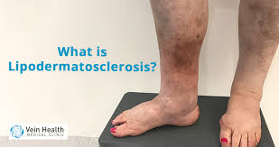 Image result for Lipodermatosclerosis