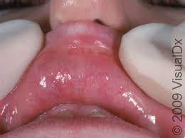 Image result for Canker sores symptoms roof of the mouth