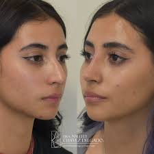 Fue su regalo de graduación!! Premiando a su esfuerzo, sus papis le  regalaron la cirugía que tanto quería!! 🤩🤩 Siento mucha emoción y alegría  el ver la satisfacción de mis pacientes; y