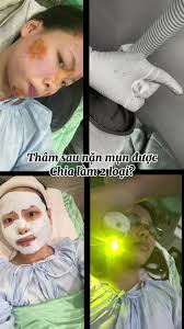Laser 585 đièu trị thâm đỏ ntnao?#laser585 #beauty #goclamdep❤️ #PhNga