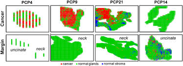 This rim is called a margin. Pancreatic Cancer Surgical Resection Margins Molecular Assessment By Mass Spectrometry Imaging