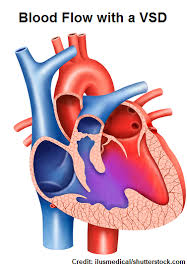 Image result for Ventricular Septal Defect