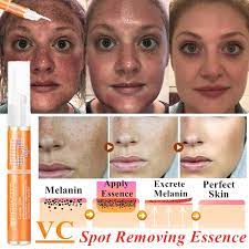 Claire chang of union square laser dermatology agrees that hydroquinone is an effect way to target melasma and likes ambi fade cream, in particular, because it also contains vitamin e and. Women Skin Freckle Dark Spot Corrector Remover For Face Melasma Treatment Fade Cream Removes Hyperpigmentation Wish