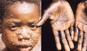 Monkeypox infection is a zoonotic viral infection that usually lasts for 3 weeks. Monkeypox Uk Virus Infection Symptoms And Signs Are Similar To Flu Express Co Uk