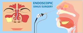Image result for Sinus Surgery