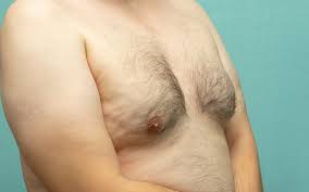 Male Gynecomastia | The Need To Know About Man Boobs