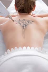 The healing process after tattoo removal is terribly obstructed due to smoking. Laser Tattoo Removal Wellington Lower Hutt Skin Deep Website