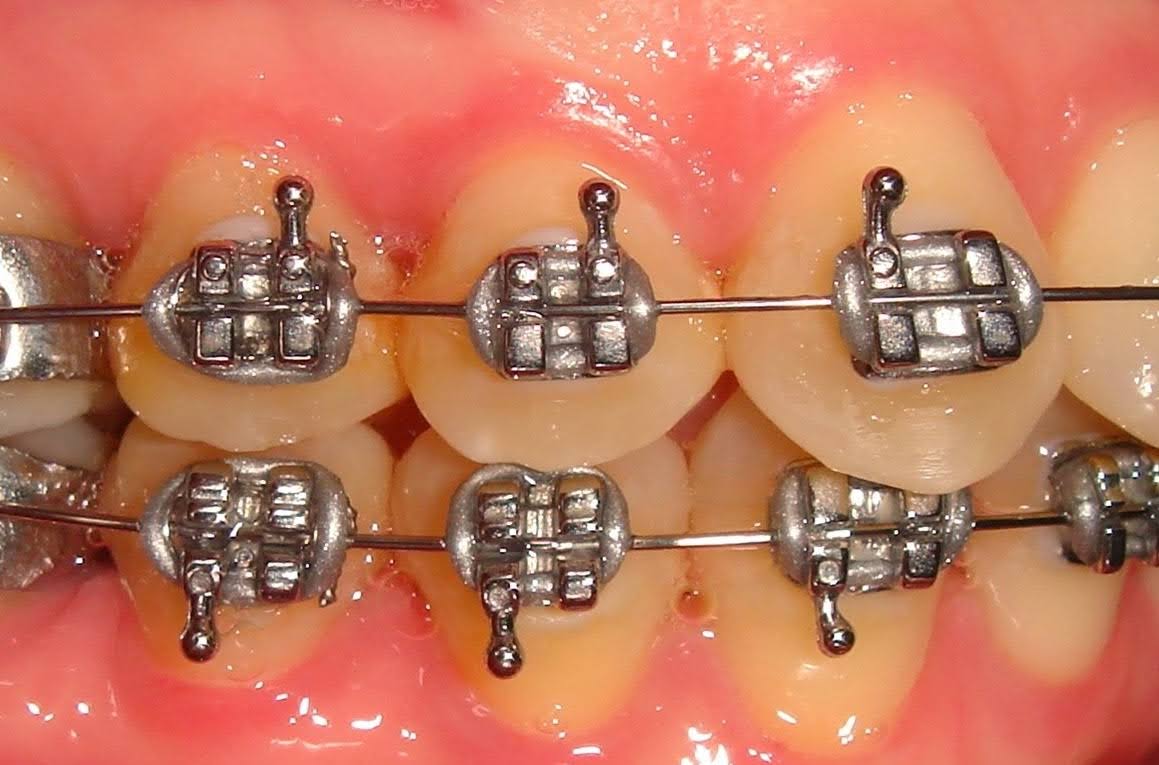 Metal Braces product image