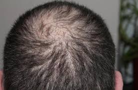 Check spelling or type a new query. Ini Tanda Rambut Rontok Akibat Stres Biasanya Di Sekitar Pelipis Himedik Com