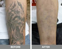 Physician owned and supervised, your tattoo removal procedure is in good hands. Laser Tattoo Removal Kucumber