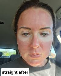 Hi there 👋 Here is Lucy. She was my model for the event and kindly sent  these photos to document how her skin reacted after her Microneedling. As  you can see, she