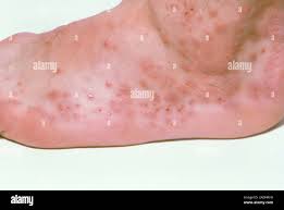 Image result for Cimex lectularius bites