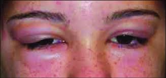 Black henna tattoo reaction, pseudotattooing, allergy to fake tattoo, temporary tattoo reaction. Severe Eyelid Swelling Following The Use Of Hair Dye 6 Months After Download Scientific Diagram