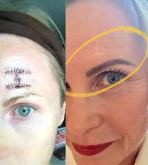 throwbackthursday In October 2014 I discovered a very small red dot above  my left eyebrow. It was a little flaky and just didn't seem quite right, so  I went to my dermatologist