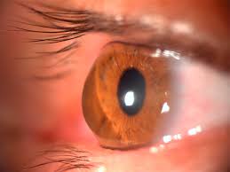 Prevenção do Ceratocone: Fatores de Risco e Medidas de Proteção Ocular - Clinic Spot Clinica Oftalmológica