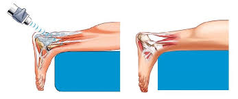 While tendinitis can occur in any of your. Peralatan Medis Bs Swt2x Gelombang Pintar Tendonitis Gelombang Kejut Pola Tendonitis Buy Tendonitis Terapi Gelombang Kejut Peralatan Medis Terapi Gelombang Kejut Patellar Tendonitis Product On Alibaba Com