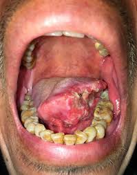 Does dippers really don't mind having their face mutilated. Oral Cancer The State Of The Art Of Modern Day Diagnosis And Treatment Intechopen
