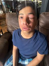 Seeking additional relief for child's skin issues beyond steroid ointment?