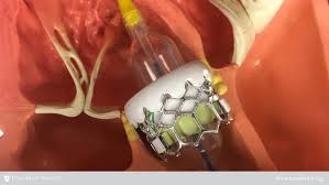 Related questions why would a mitral valve leak only a few weeks after an aortic valve replacement? Can Tavr Replace A Mechanical Aortic Valve That Was Put In Place 13 Years Ago Texas Heart Institute
