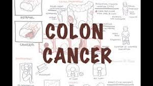 Stage 1 tumors are often removed at the time of colonoscopy, while surgery is the main recommended therapy for stage 2 and. Colorectal Cancer Physiopedia