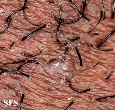Razor bumps occur when shaved hairs get trapped inside the skin, causing lesions that resemble acne. Ingrown Hair Prevention Infection Scars Pictures Cure Removal Ehealthstar