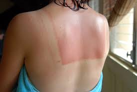 Image result for Sunburn
