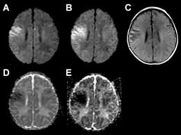 Hatipoglu hg(1), sakman b, yuksel e. Diffusion Weighted Mri For Early Diagnosis Of Neonatal Herpes Simplex Encephalitis Sciencedirect