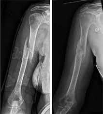 A sarmiento brace is used to stabilize a fracture in your upper arm while leaving your elbow free, allowing motion in your forearm and hand. Humerus Fracture Joseph J Schreiber Md