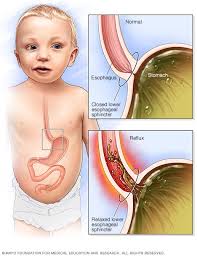 Spitting Up In Babies Whats Normal Whats Not Mayo Clinic