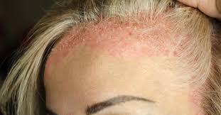 Image result for psoriasis