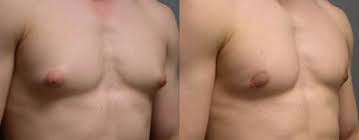 Breast Augmentation - Macleod Trail Plastic Surgery In Calgary
