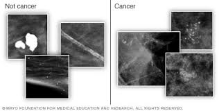 Dcis (ductal carcinoma in situ) can be considered as the initial stage of breast cancer. Ductal Carcinoma In Situ Dcis Diagnosis And Treatment Mayo Clinic