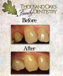 Case Presentation Premolar Crown Case Presentation Dental Ceramics Presentation