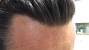 Hair System Before And After